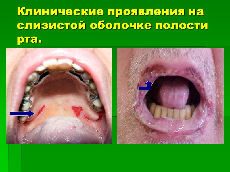 Клинические проявления на слизистой оболочке полости рта.